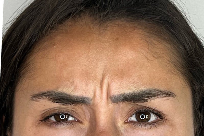 BOTOX Before & After Gallery - Patient 344438 - Image 3