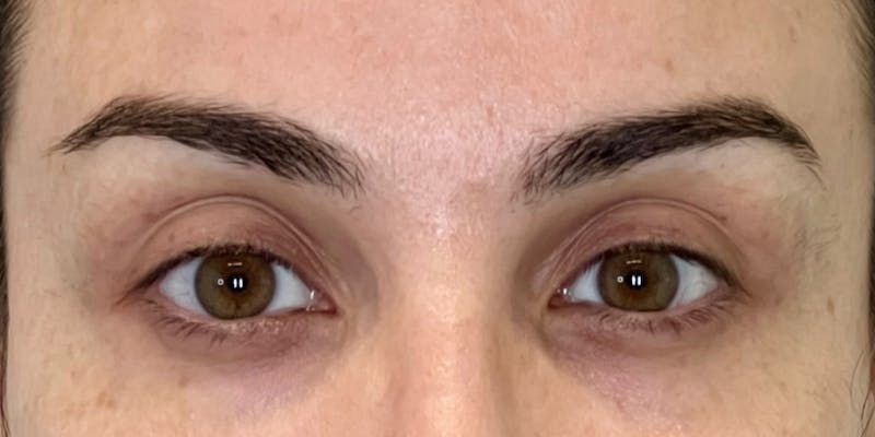 Dysport Before & After Gallery - Patient 349832 - Image 6