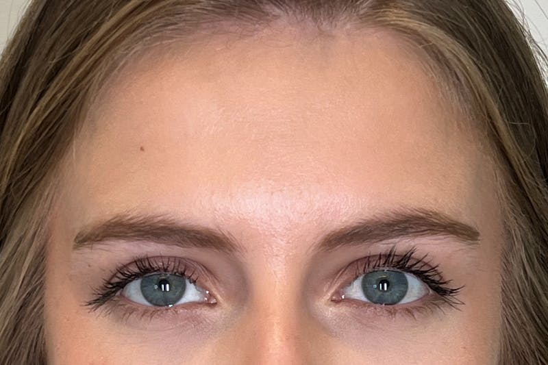 BOTOX Before & After Gallery - Patient 913658 - Image 5