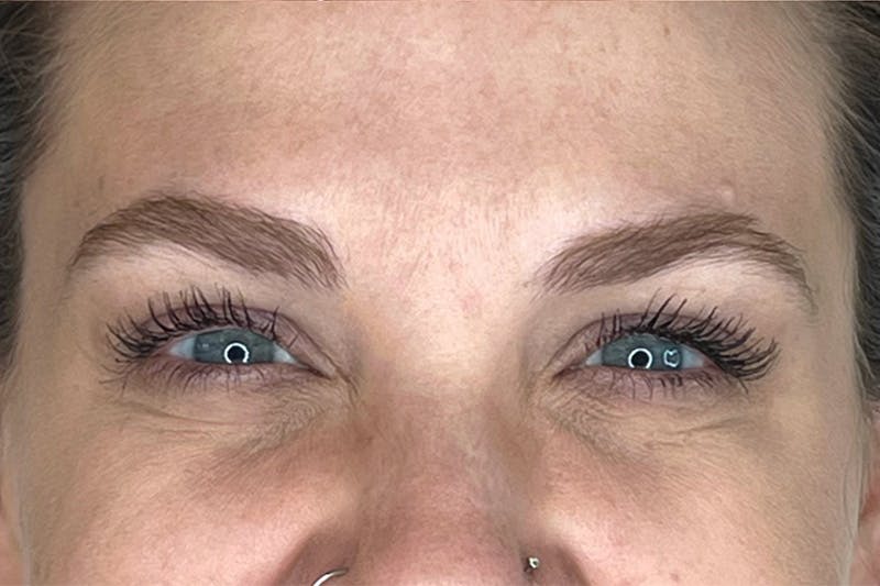 BOTOX Before & After Gallery - Patient 283220 - Image 6
