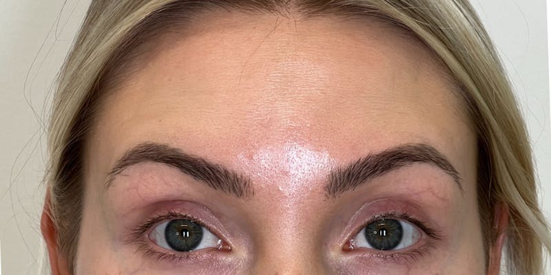 BOTOX Before & After Gallery - Patient 228341 - Image 2