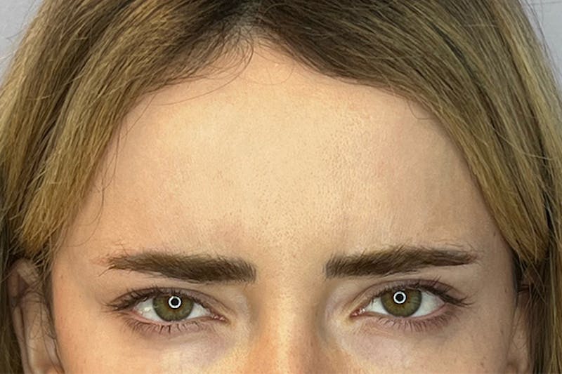 BOTOX Before & After Gallery - Patient 236004 - Image 4