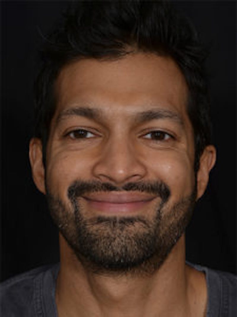 Male Face & Neck Before & After Gallery - Patient 452117 - Image 1