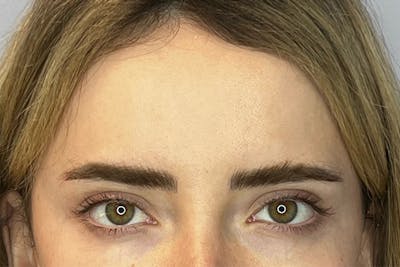 BOTOX Before & After Gallery - Patient 236004 - Image 2