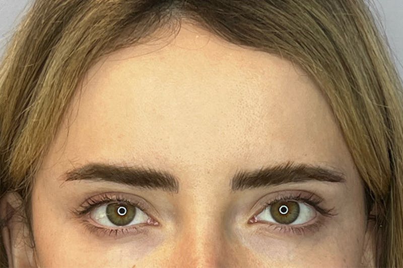 BOTOX Before & After Gallery - Patient 236004 - Image 2