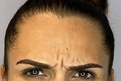 BOTOX Before & After Gallery - Patient 149423 - Image 1