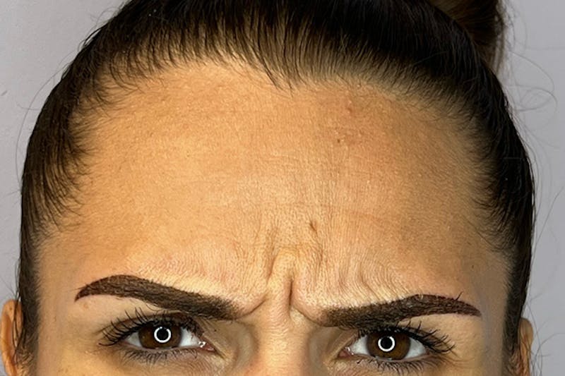 BOTOX Before & After Gallery - Patient 149423 - Image 1