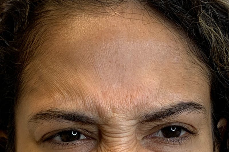 BOTOX Before & After Gallery - Patient 246260 - Image 1