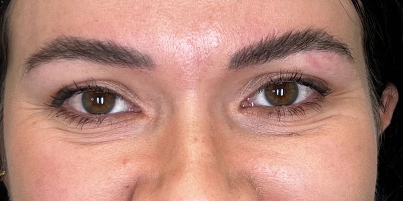 Dysport Before & After Gallery - Patient 192220 - Image 3