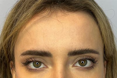 BOTOX Before & After Gallery - Patient 236004 - Image 1