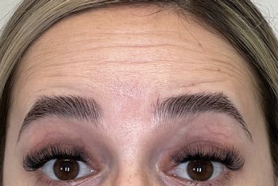BOTOX Before & After Gallery - Patient 629113 - Image 1