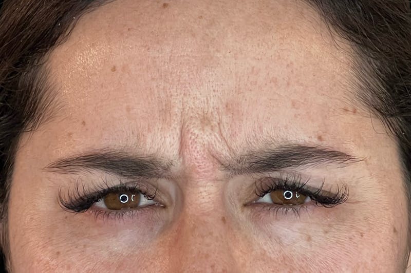 BOTOX Before & After Gallery - Patient 105783 - Image 3