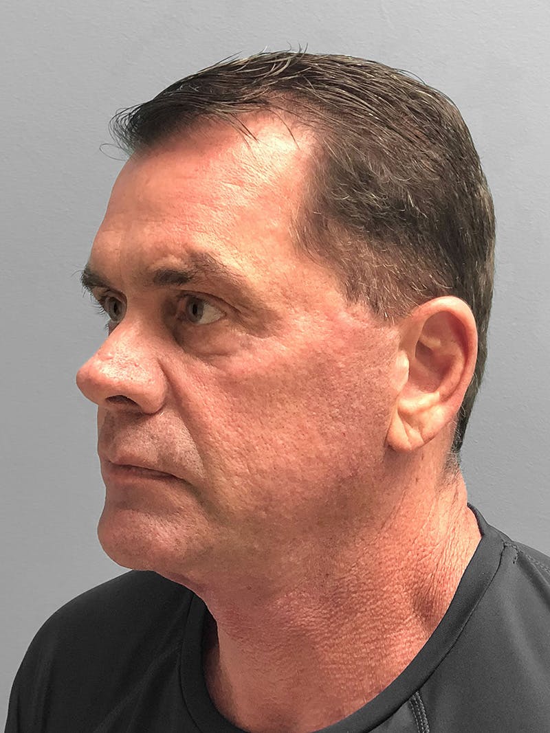 Facelift Before & After Gallery - Patient 267618 - Image 1