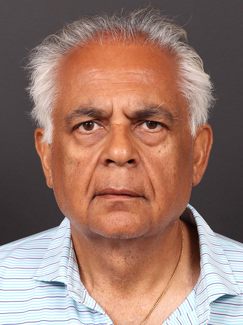 Male Face & Neck Before & After Gallery - Patient 114462 - Image 1