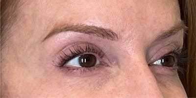 Dysport Before & After Gallery - Patient 222436 - Image 2
