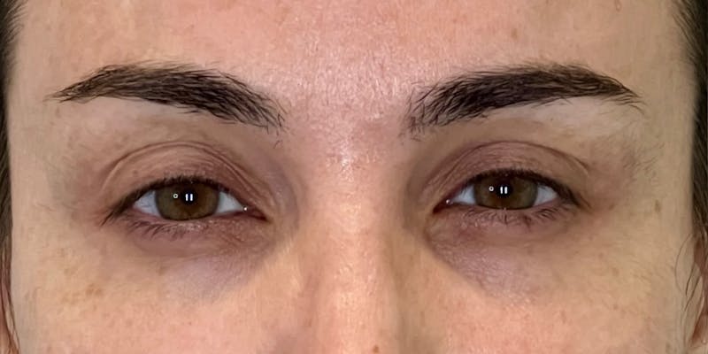 Dysport Before & After Gallery - Patient 349832 - Image 2