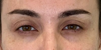 Dysport Before & After Gallery - Patient 349832 - Image 2