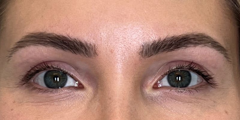 BOTOX Before & After Gallery - Patient 228341 - Image 5