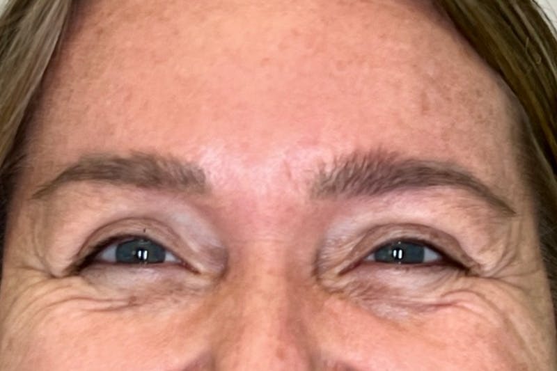 BOTOX Before & After Gallery - Patient 165391 - Image 3