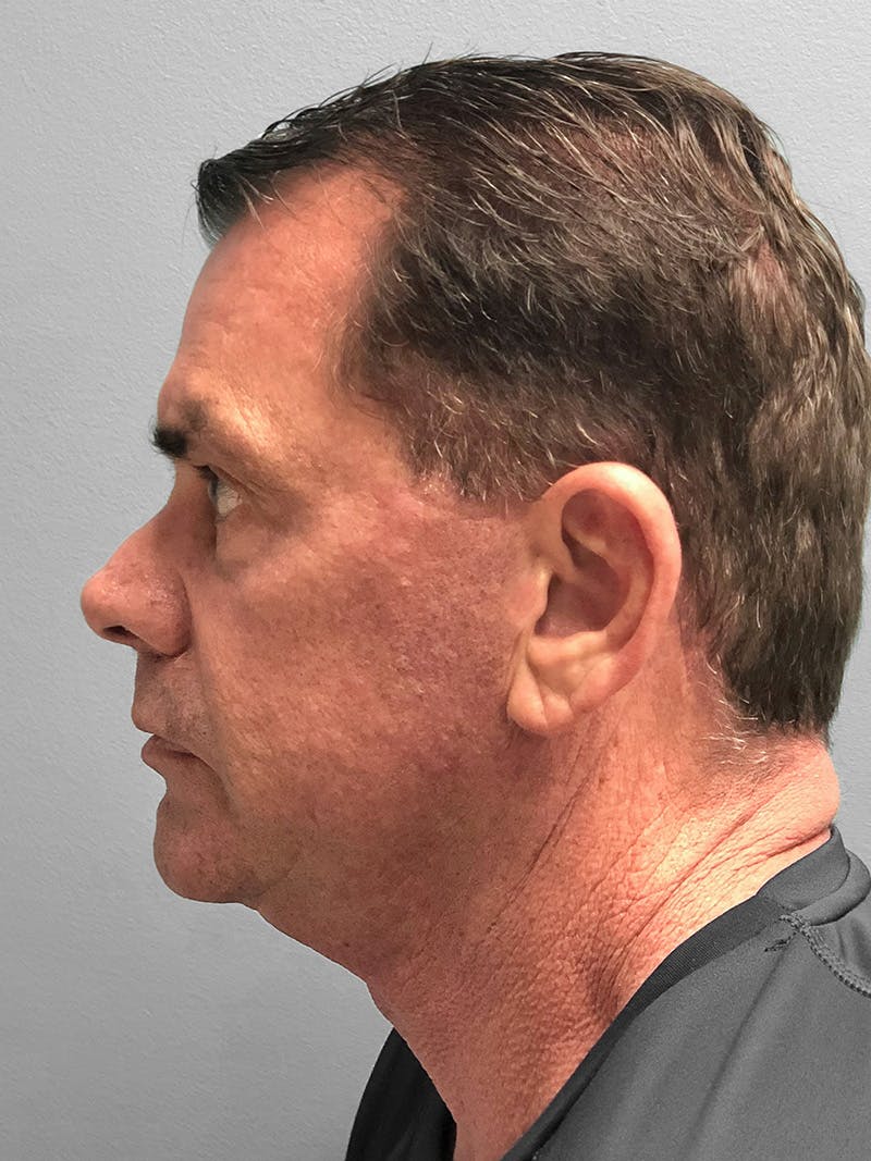 Facelift Before & After Gallery - Patient 267618 - Image 3
