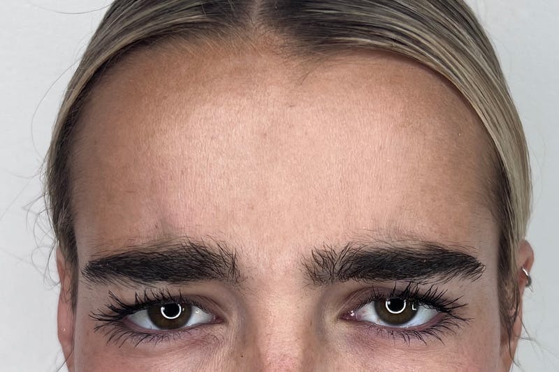 BOTOX Before & After Gallery - Patient 356623 - Image 6