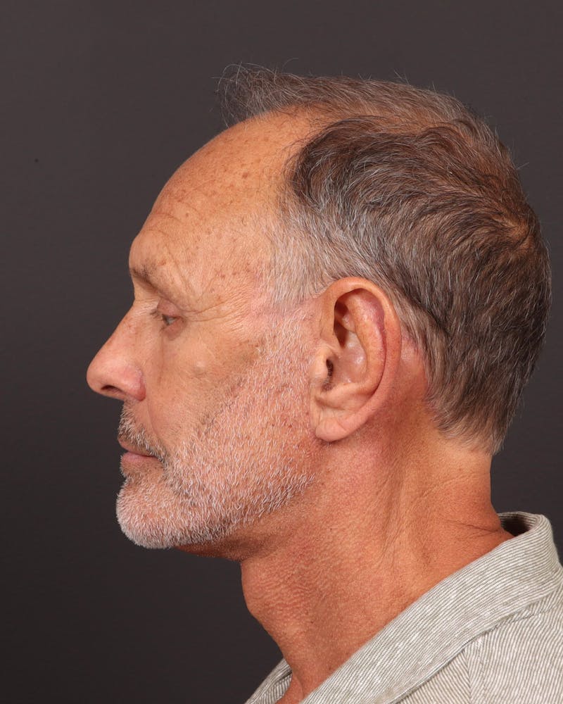 Facelift Before & After Gallery - Patient 501762 - Image 4