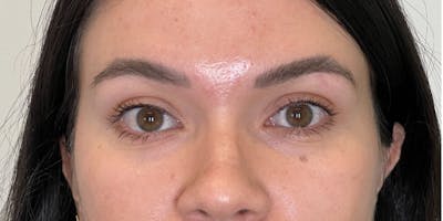 Dysport Before & After Gallery - Patient 192220 - Image 2