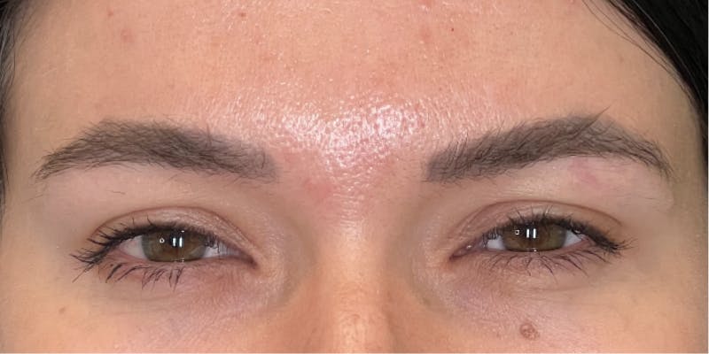 Dysport Before & After Gallery - Patient 192220 - Image 8