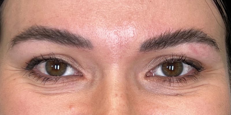Dysport Before & After Gallery - Patient 192220 - Image 9