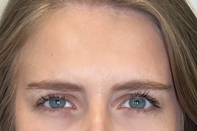 BOTOX Before & After Gallery - Patient 913658 - Image 2