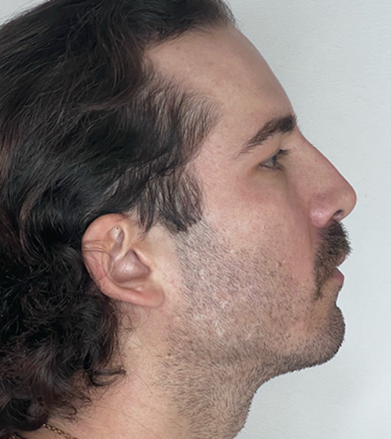 PRF Before & After Gallery - Patient 352072 - Image 2
