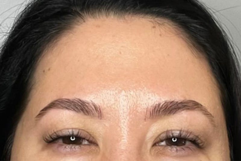 Dysport Before & After Gallery - Patient 209788 - Image 2