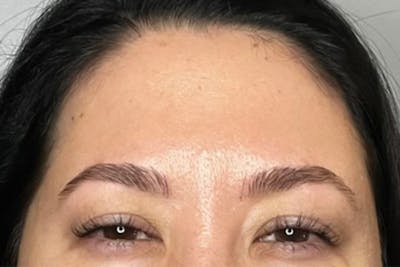 Dysport Before & After Gallery - Patient 209788 - Image 2