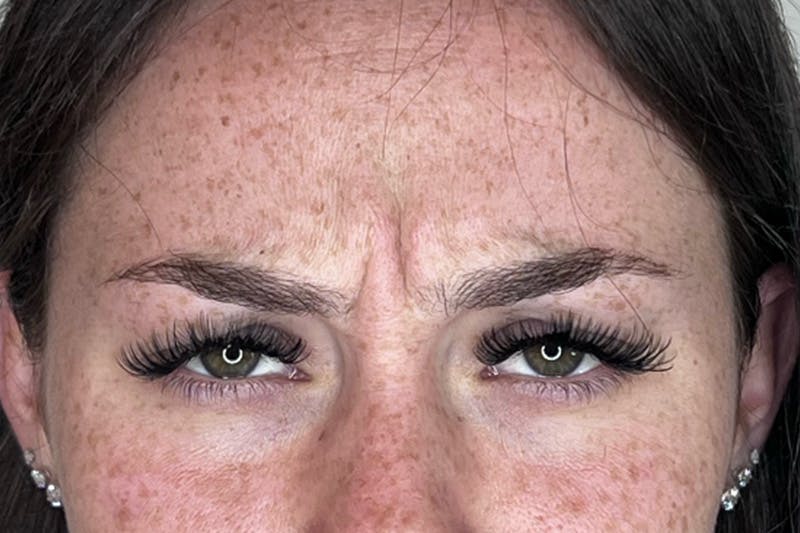 BOTOX Before & After Gallery - Patient 227379 - Image 5