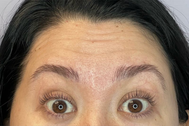 Dysport Before & After Gallery - Patient 209788 - Image 3