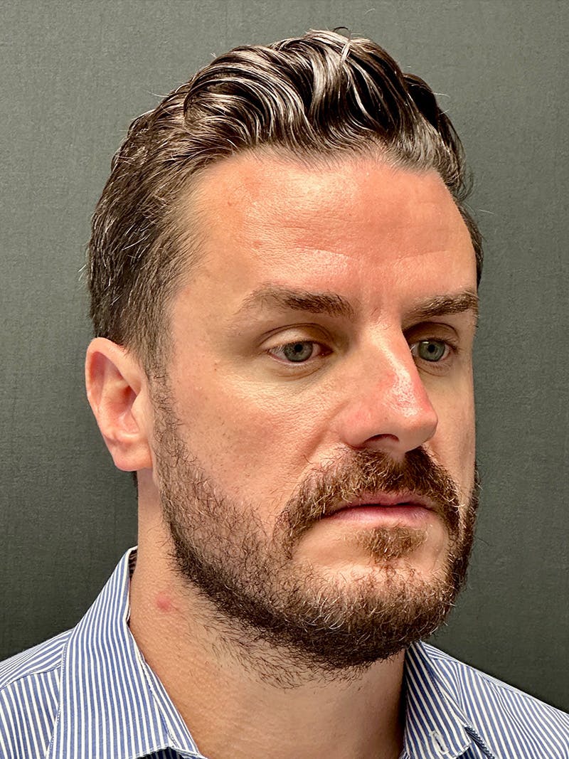 Male Face & Neck Before & After Gallery - Patient 114598 - Image 3