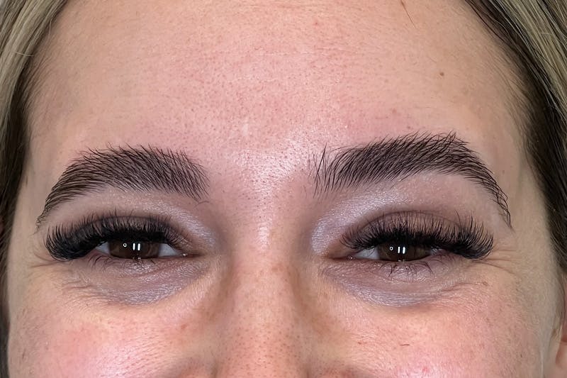 BOTOX Before & After Gallery - Patient 629113 - Image 3