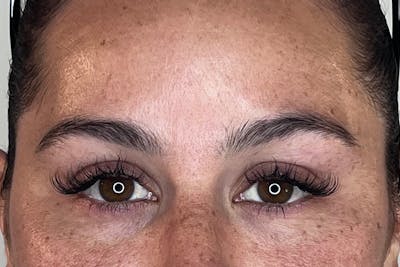 BOTOX Before & After Gallery - Patient 105783 - Image 2