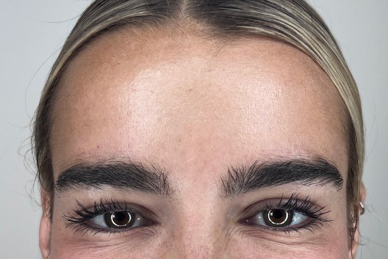 BOTOX Before & After Gallery - Patient 356623 - Image 4