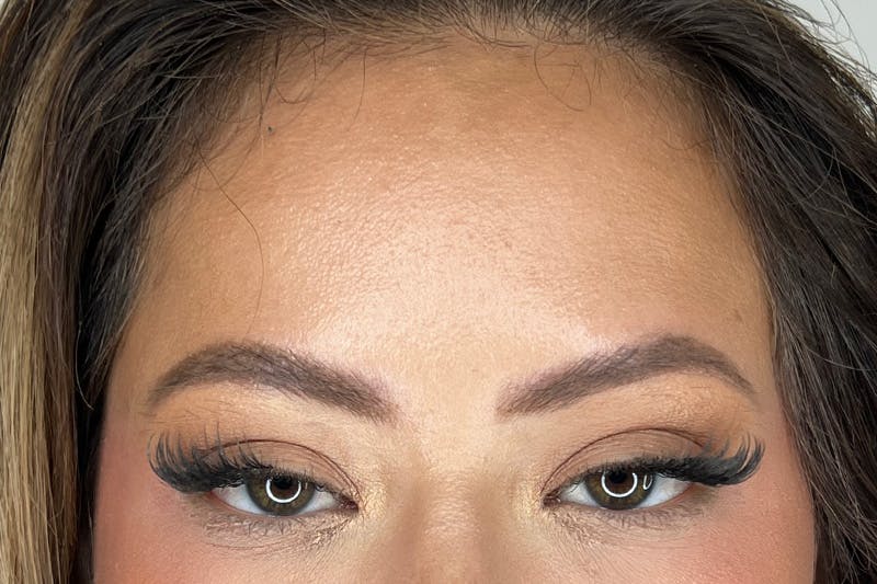 BOTOX Before & After Gallery - Patient 491781 - Image 4