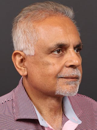 Male Face & Neck Before & After Gallery - Patient 114462 - Image 4