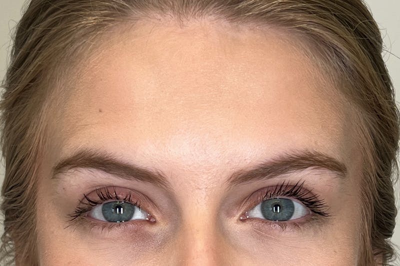 BOTOX Before & After Gallery - Patient 913658 - Image 4