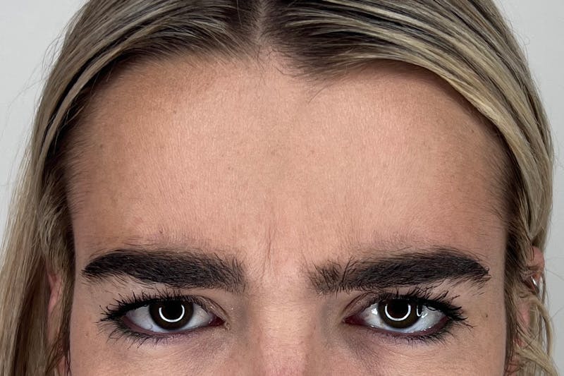 BOTOX Before & After Gallery - Patient 356623 - Image 5