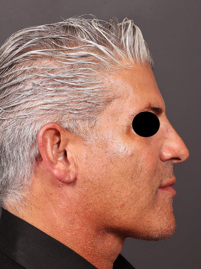 Neck Lift Before & After Gallery - Patient 417192 - Image 6