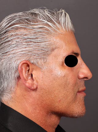 Neck Lift Before & After Gallery - Patient 417192 - Image 6
