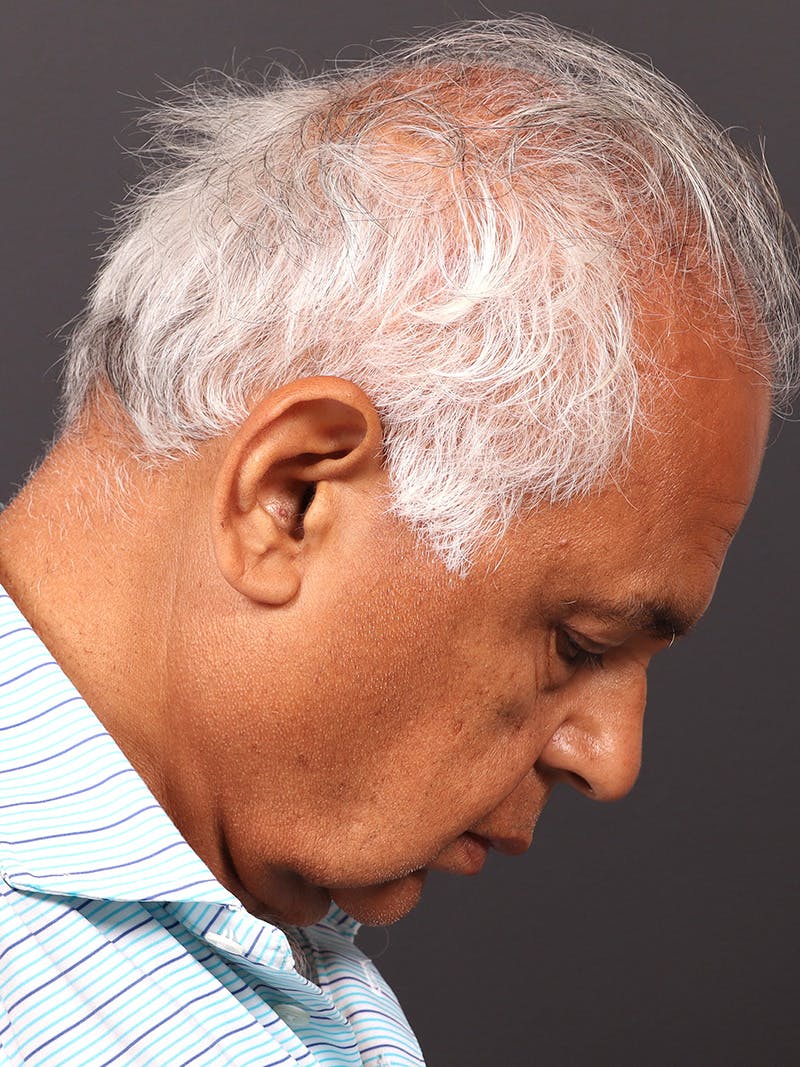 Male Face & Neck Before & After Gallery - Patient 114462 - Image 7