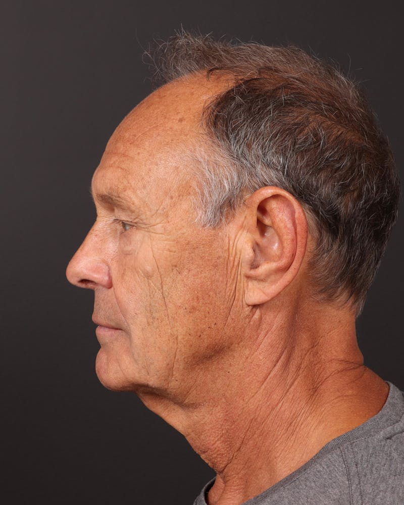 Facelift Before & After Gallery - Patient 501762 - Image 3