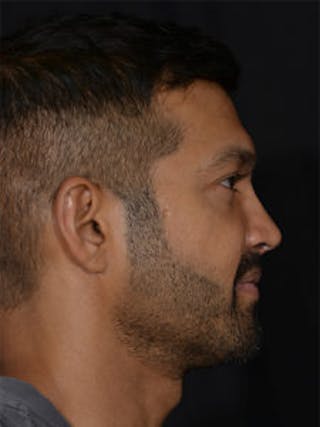 Male Face & Neck Before & After Gallery - Patient 452117 - Image 6