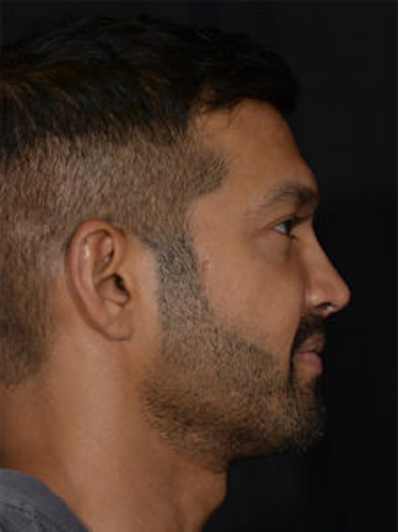 Male Face & Neck Before & After Gallery - Patient 452117 - Image 6