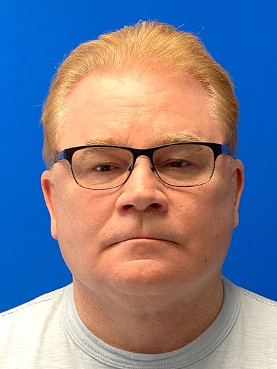 Male Face & Neck Before & After Gallery - Patient 115786 - Image 2
